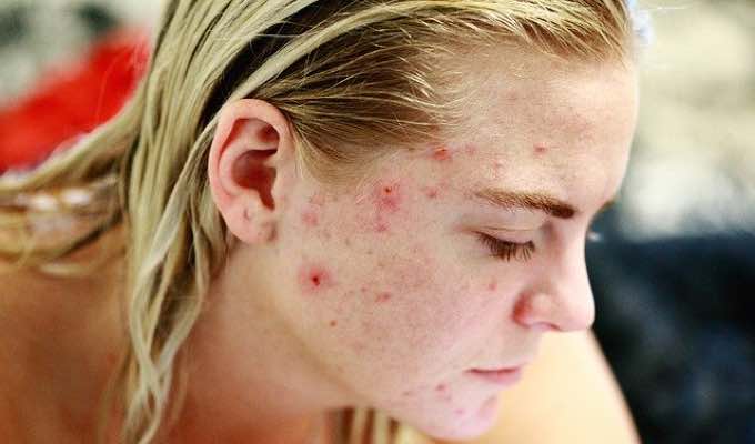 When Should You See a Doctor for Acne?