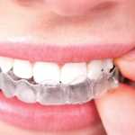 Are Teeth Aligners Safe to Use?