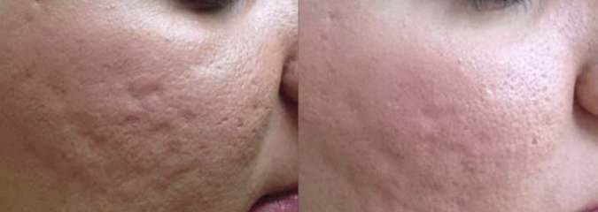 The Benefits & Process of Microneedling Treatment Explained